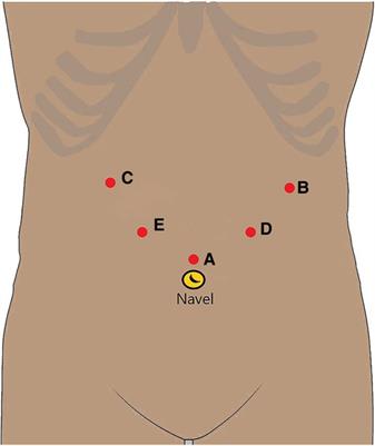 Safety, efficacy, and selection strategy of laparoscopic local gastrectomy for gastrointestinal stromal tumors in the esophagogastric junction